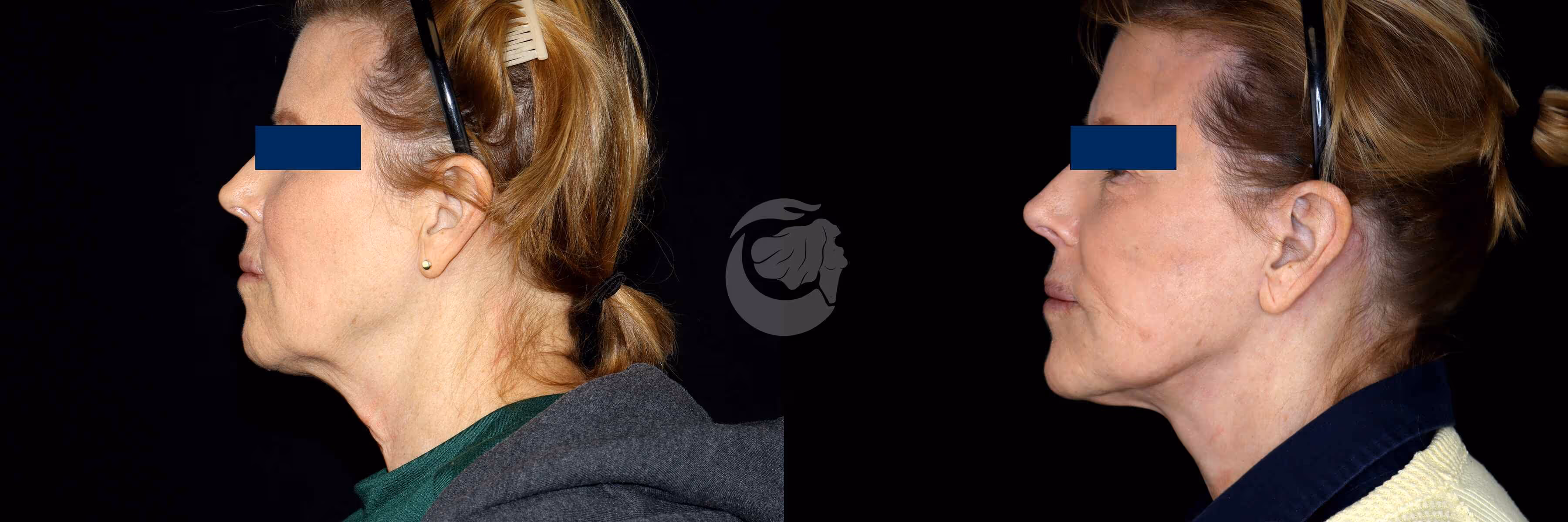Before And After Patient Image