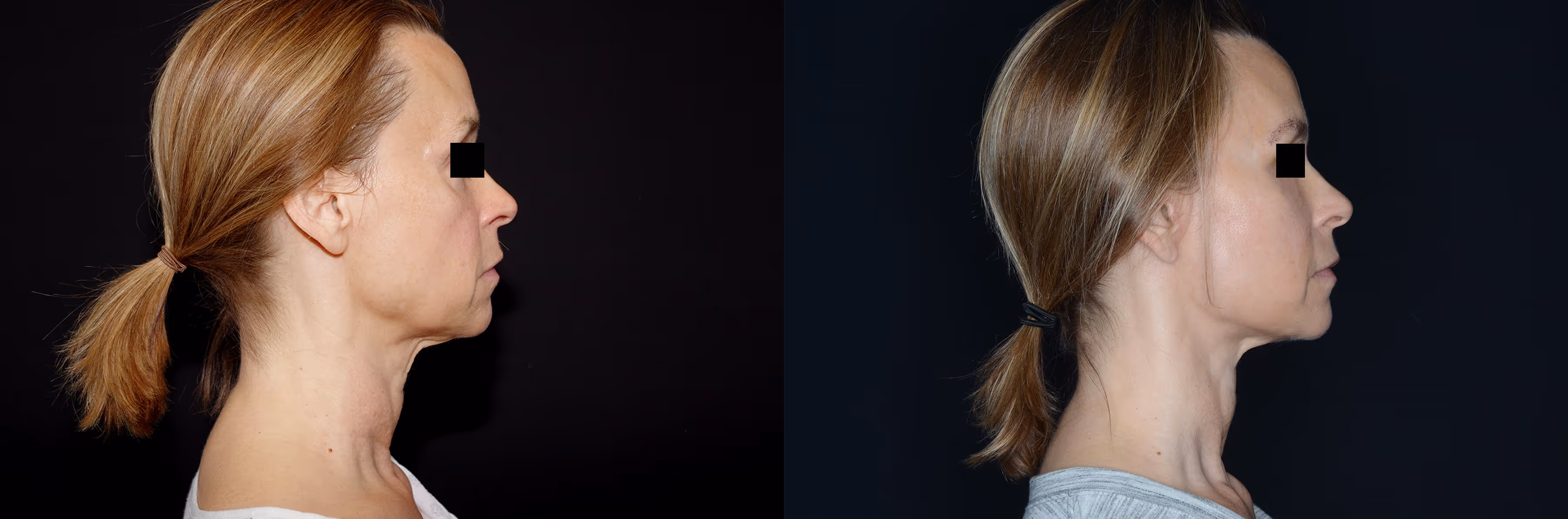 Before And After Patient Image