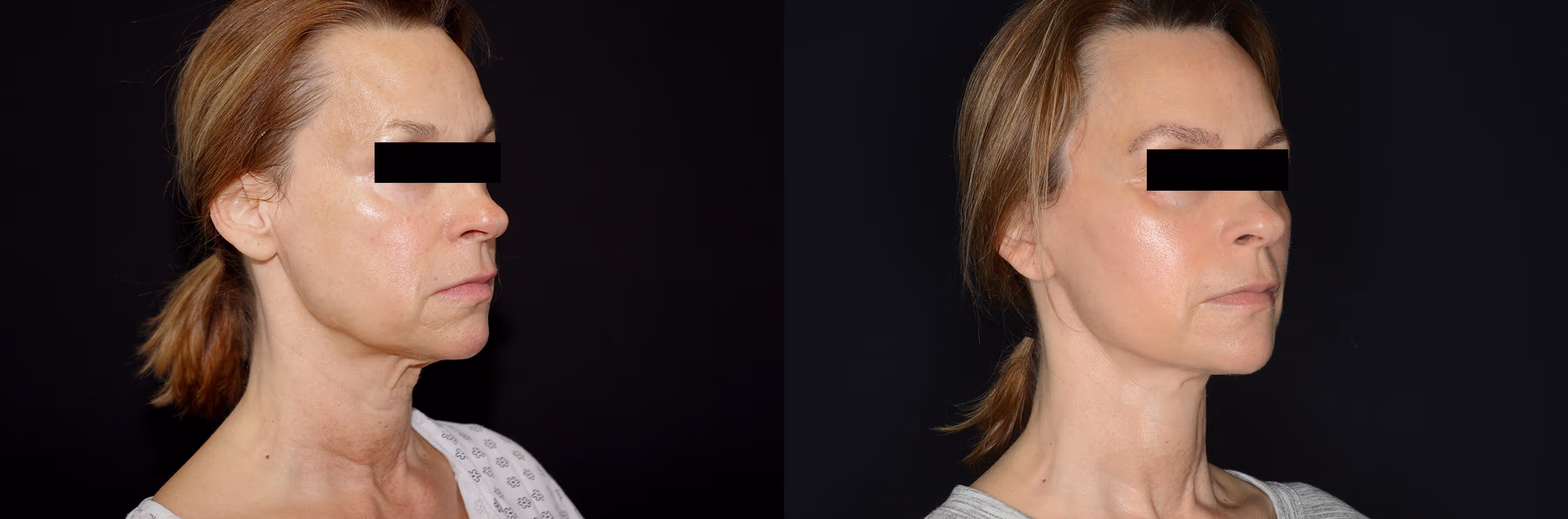 Before And After Patient Image