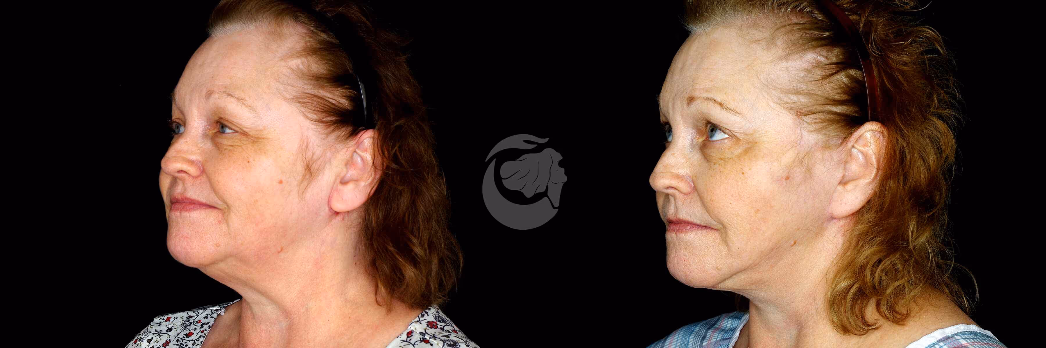 Before And After Patient Image