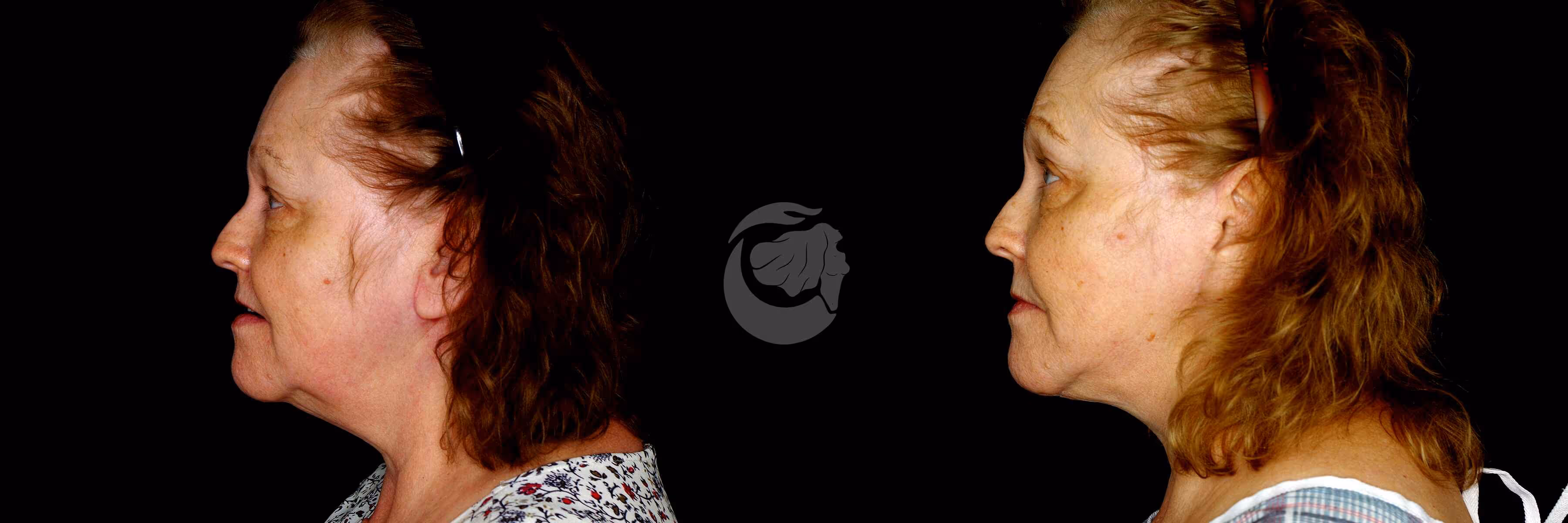 Before And After Patient Image