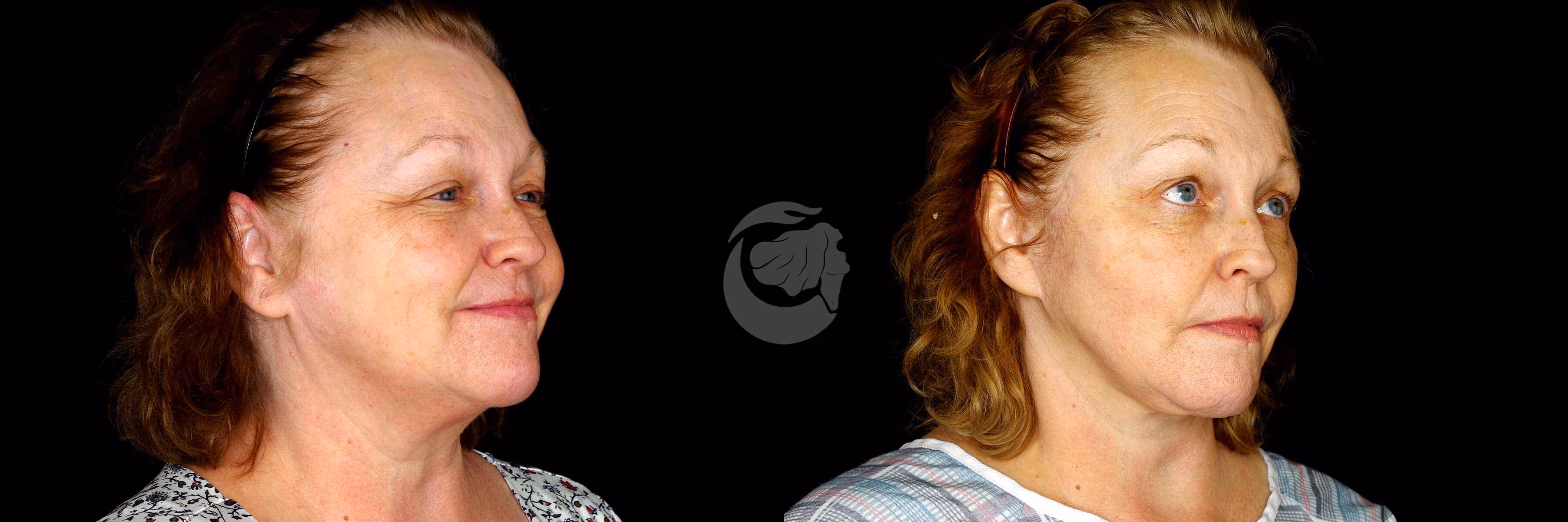 Before And After Patient Image