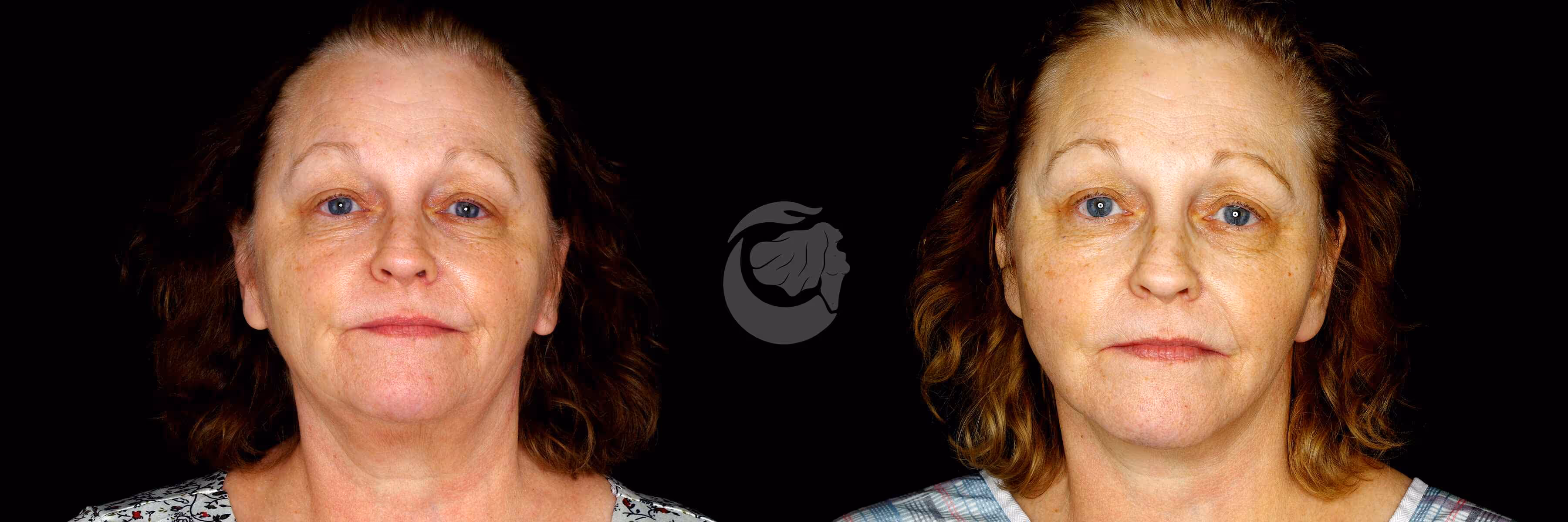 Before And After Patient Image