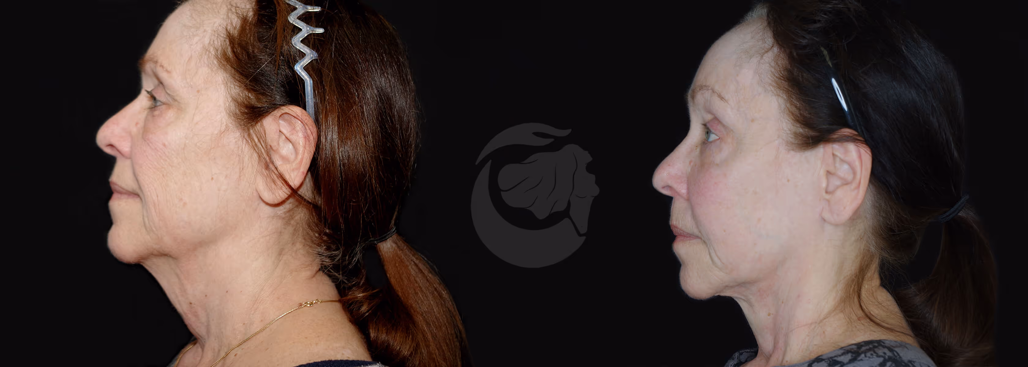 Before And After Patient Image