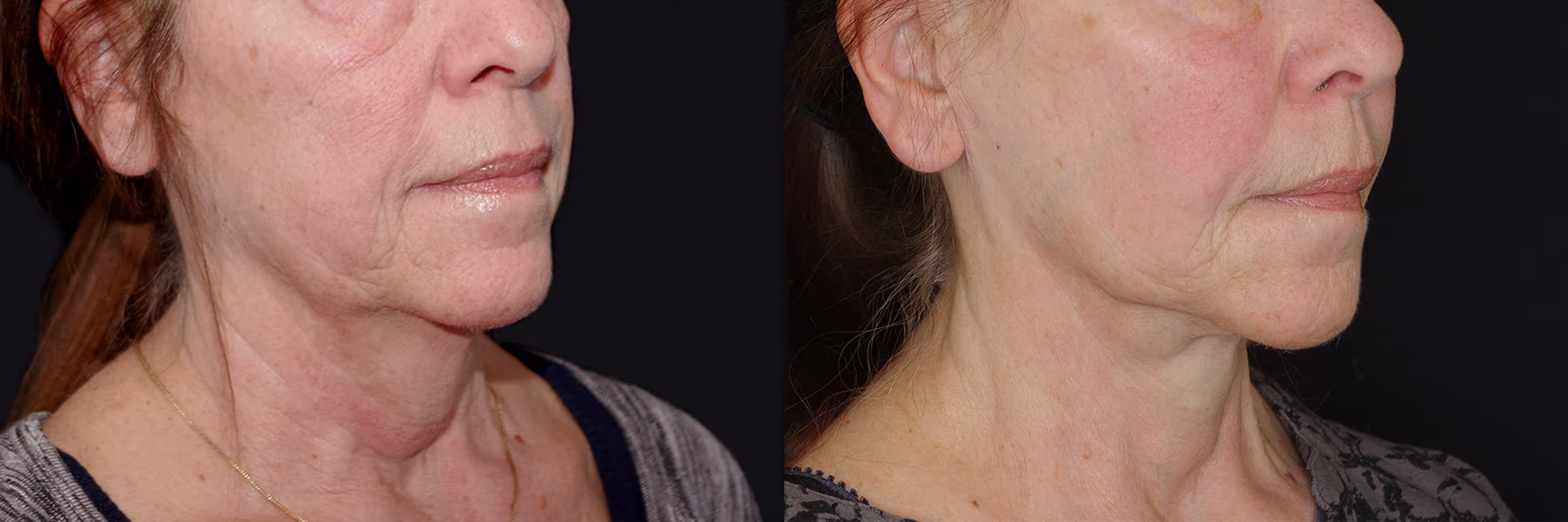 Before And After Patient Image