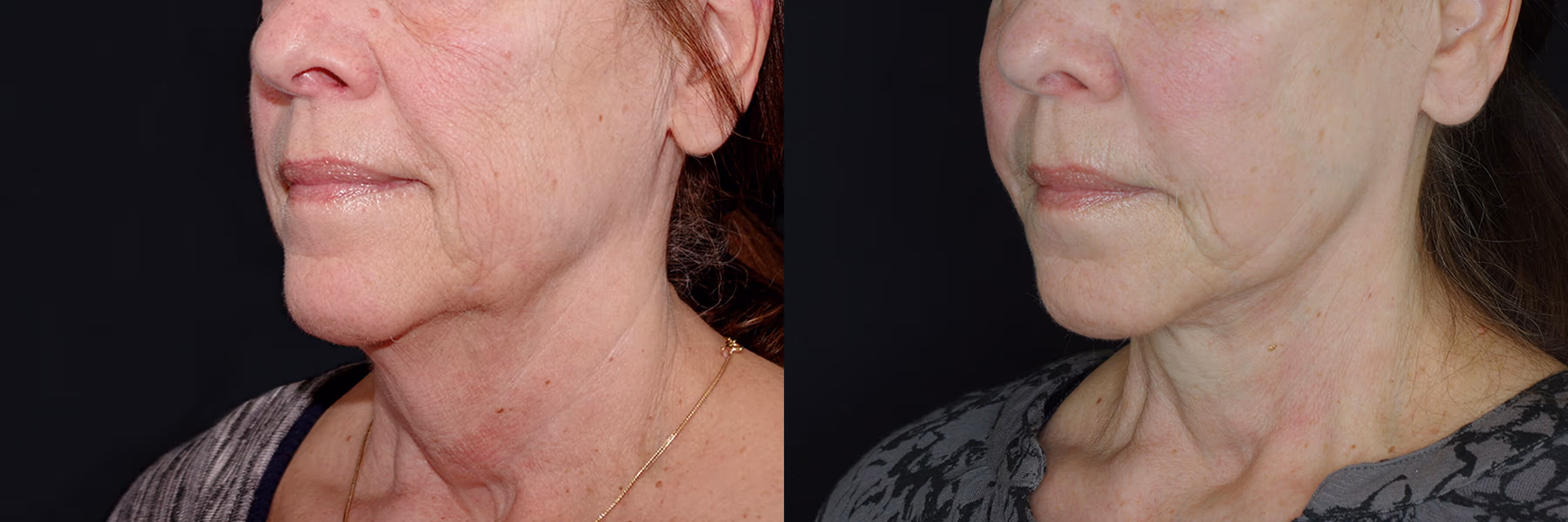 Before And After Patient Image