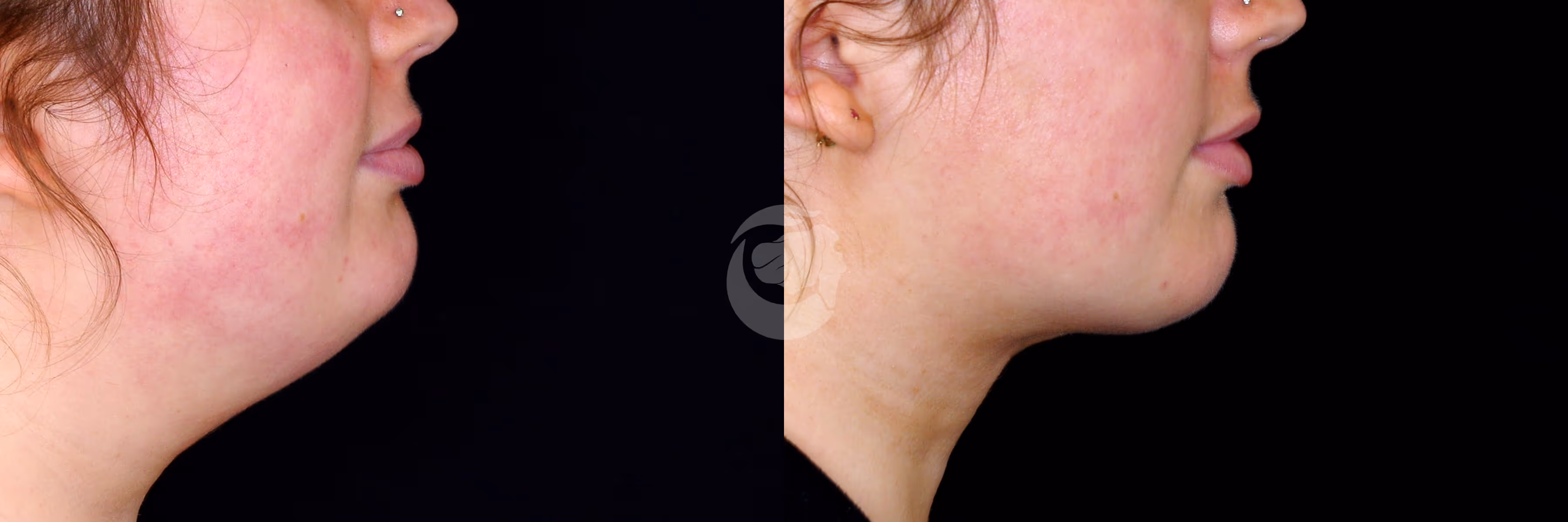 Before And After Patient Image
