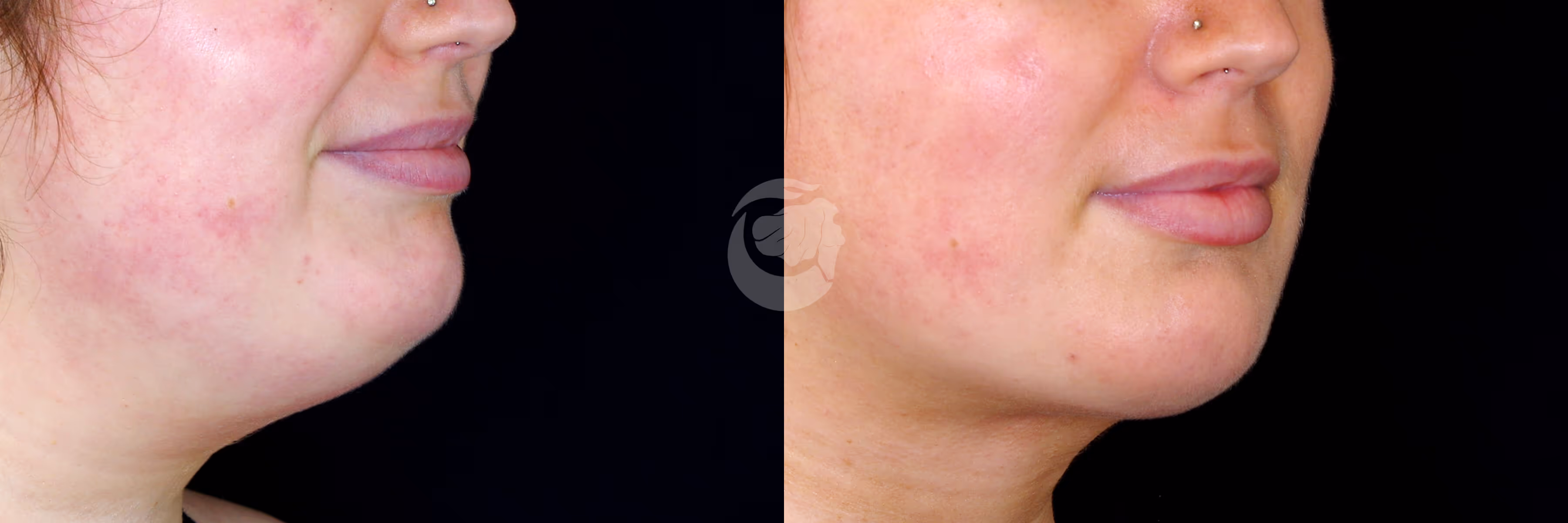 Before And After Patient Image