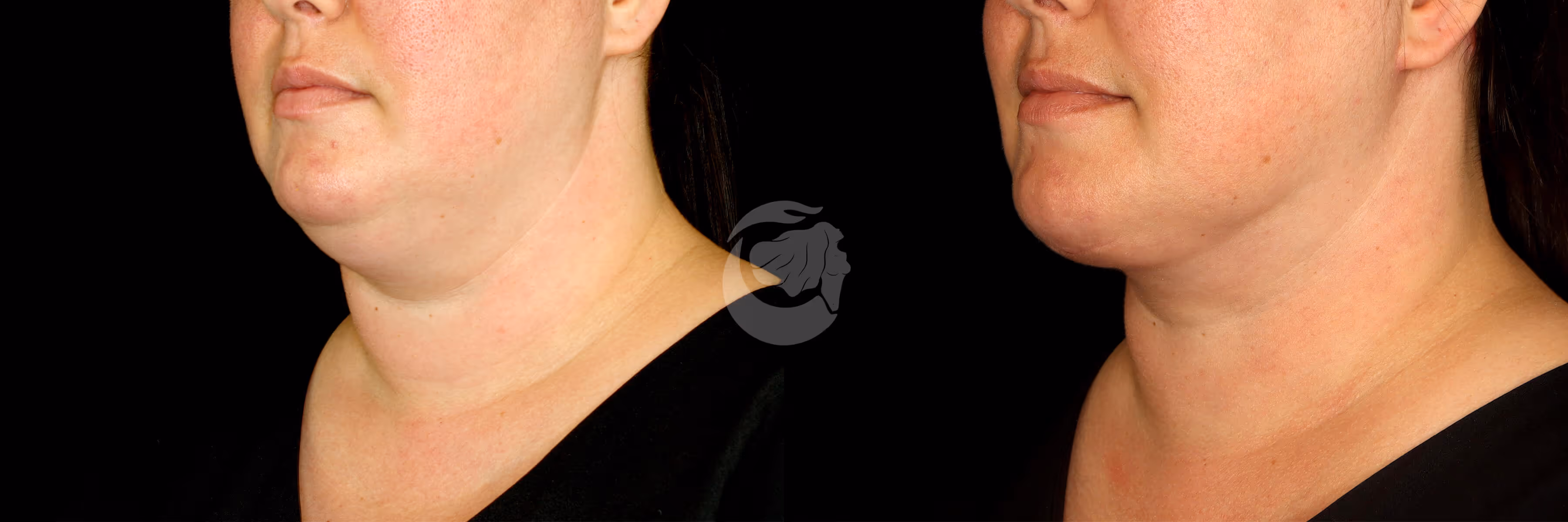 Before And After Patient Image