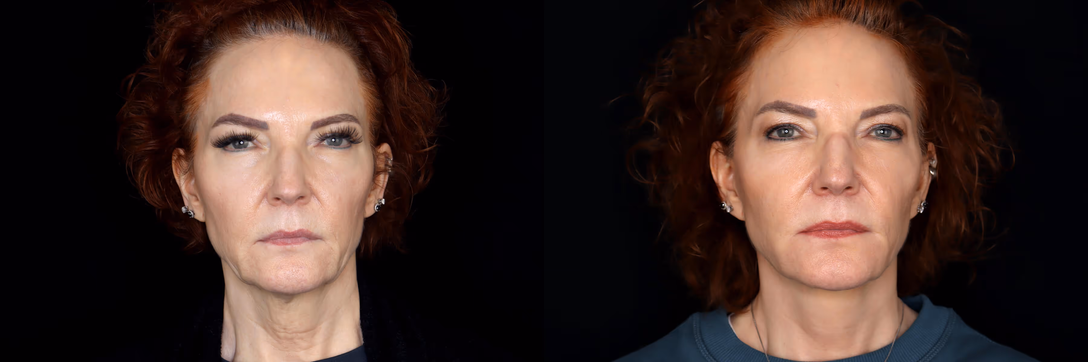 Before And After Patient Image