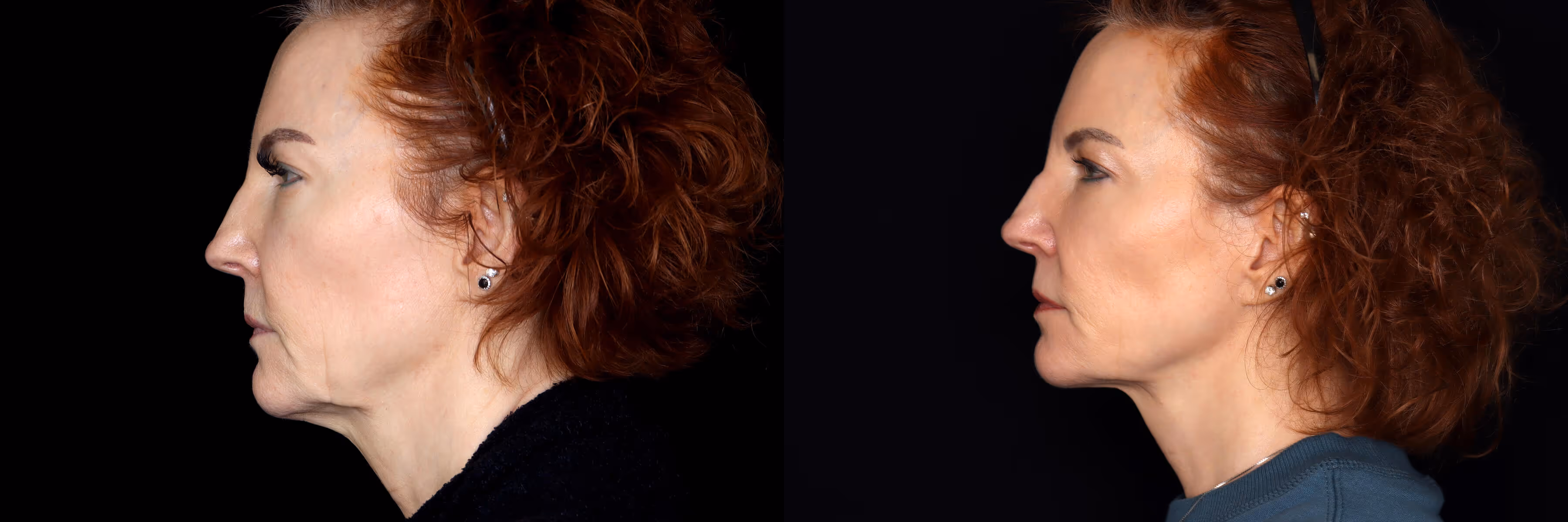 Before And After Patient Image