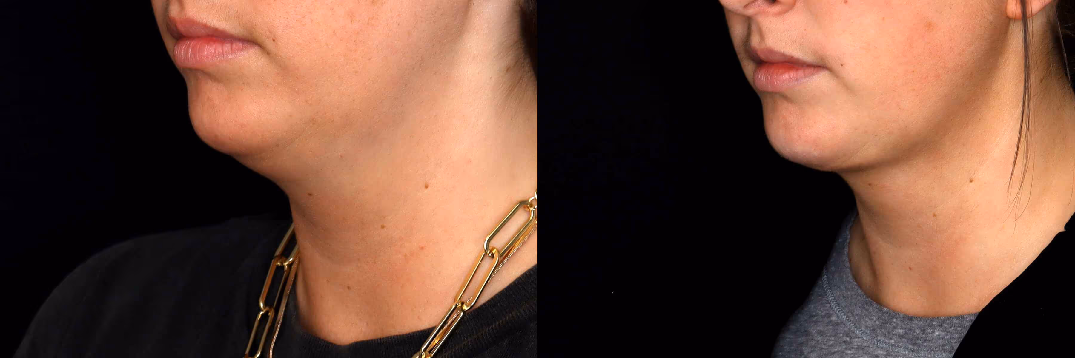 Before And After Patient Image