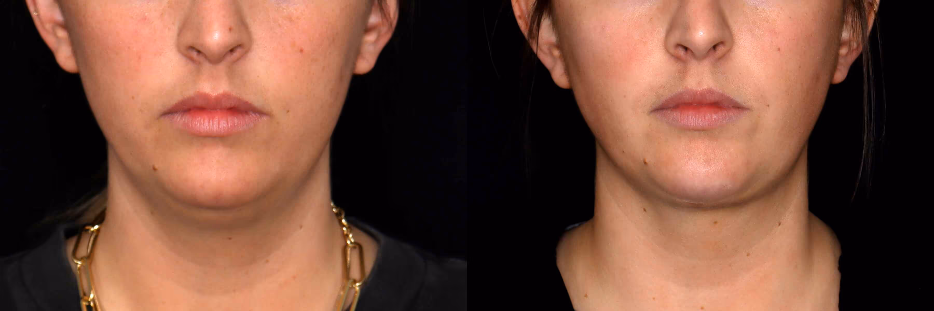 Before And After Patient Image