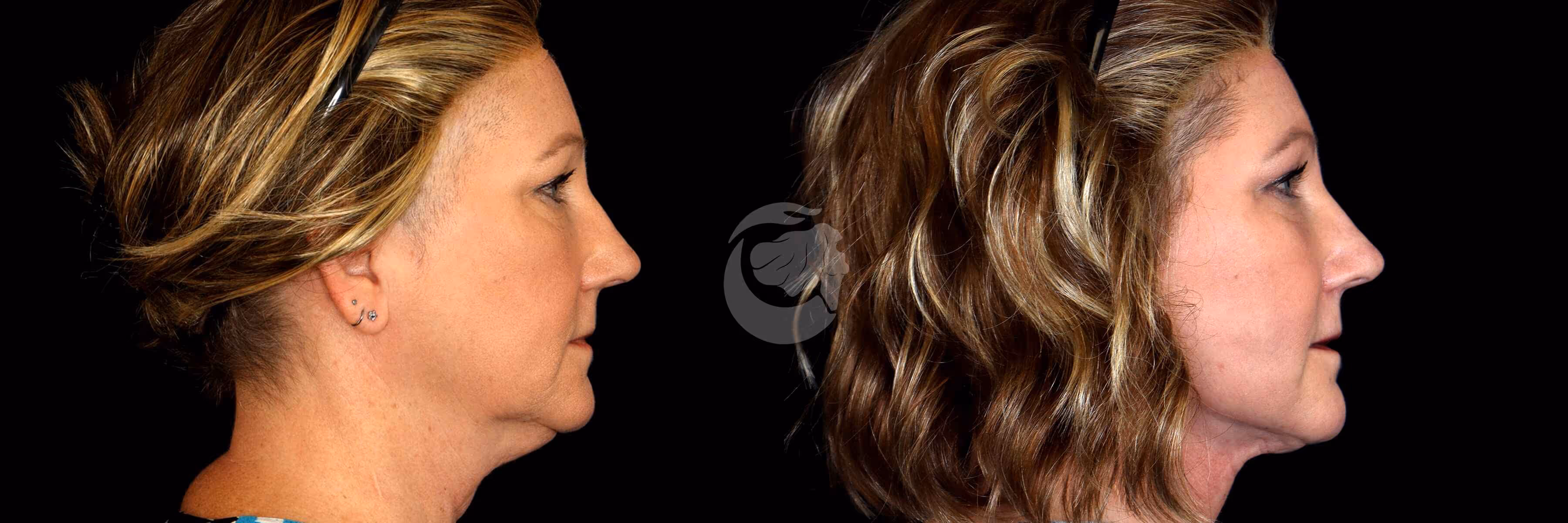 Before And After Patient Image
