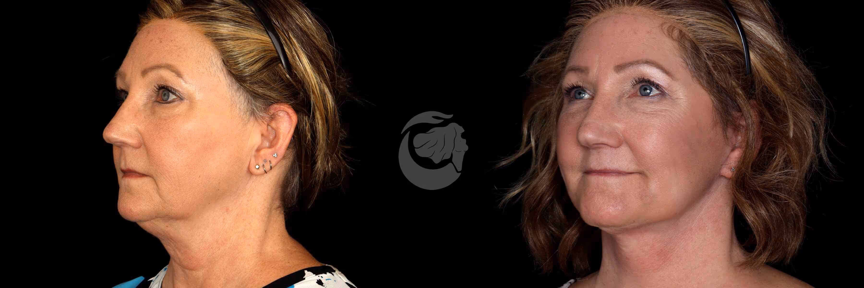 Before And After Patient Image