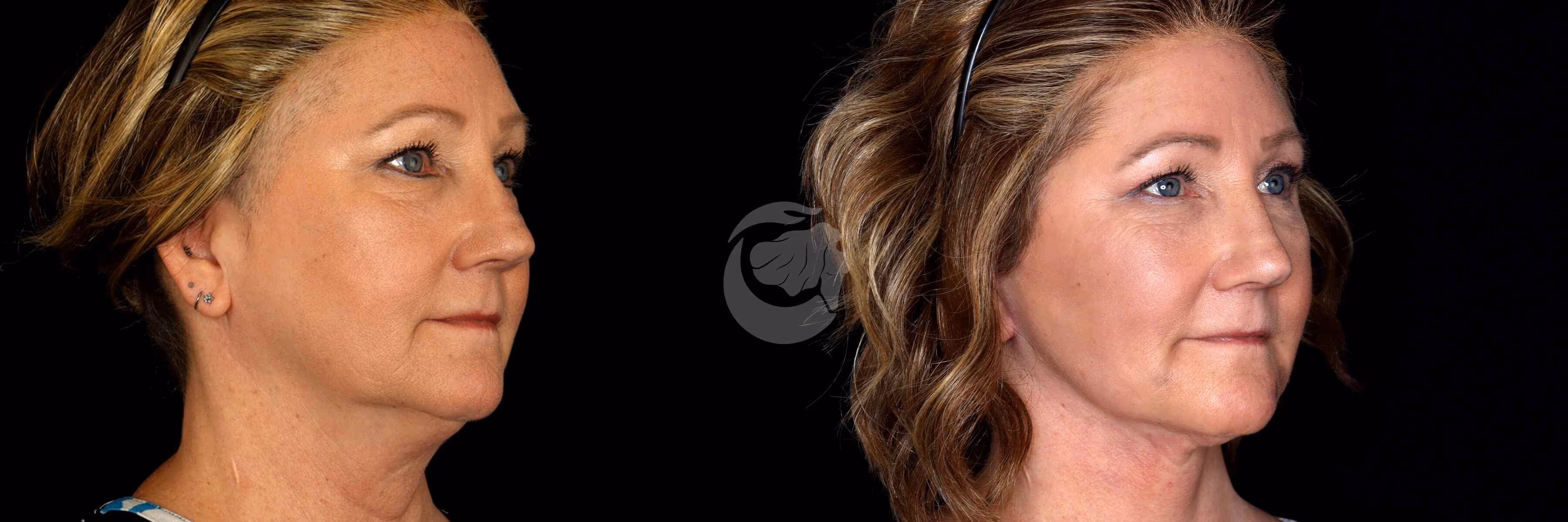 Before And After Patient Image