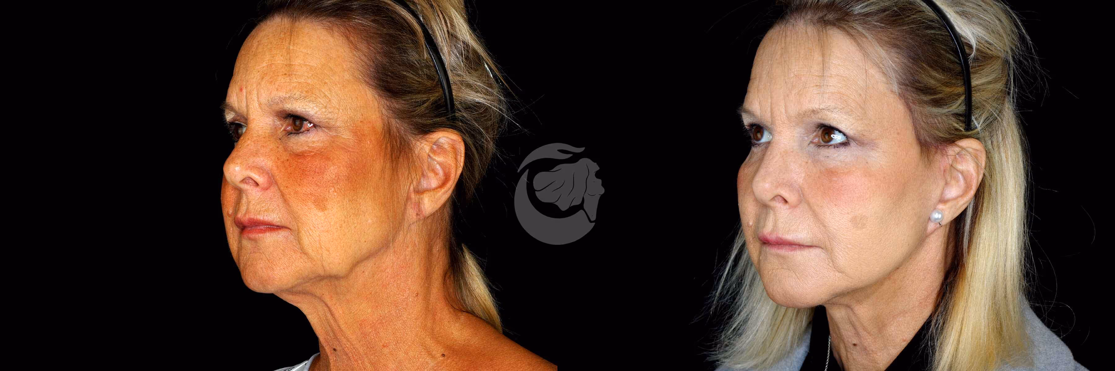 Before And After Patient Image