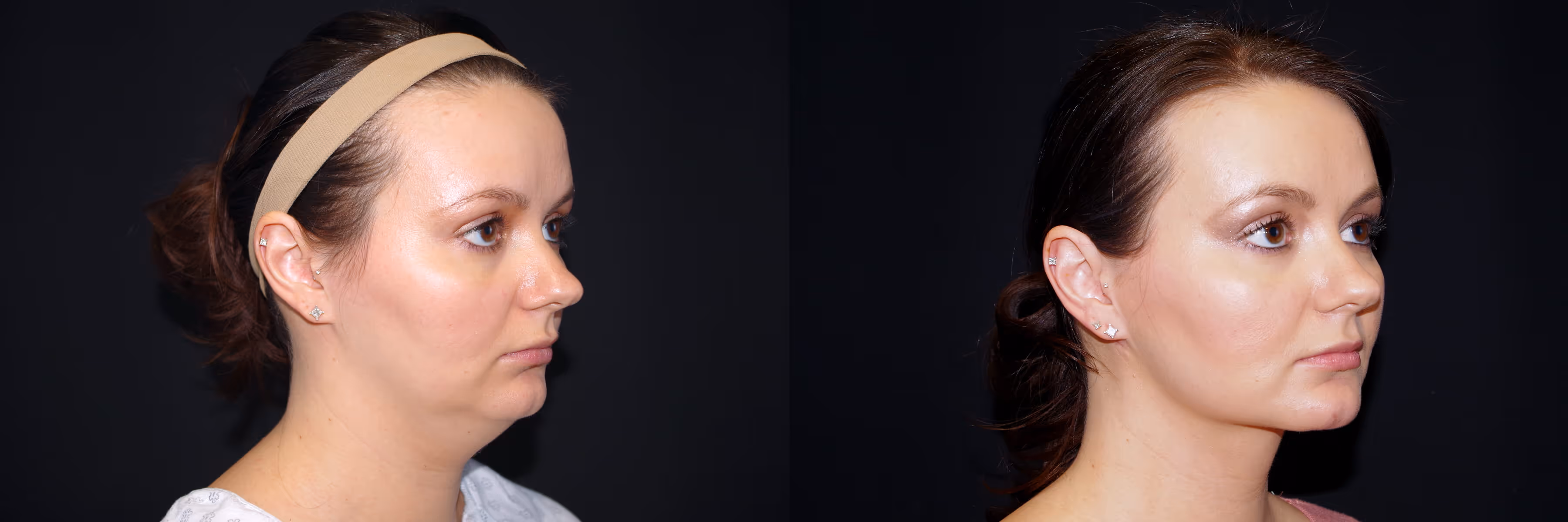 Before And After Patient Image