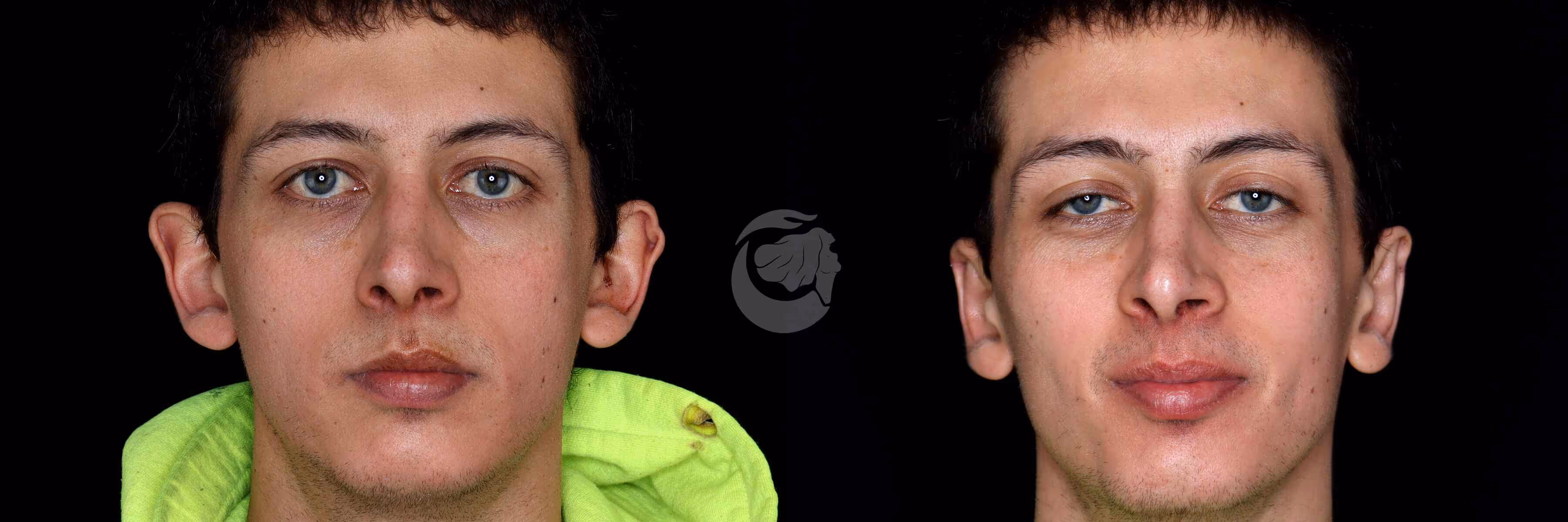Before And After Patient Image