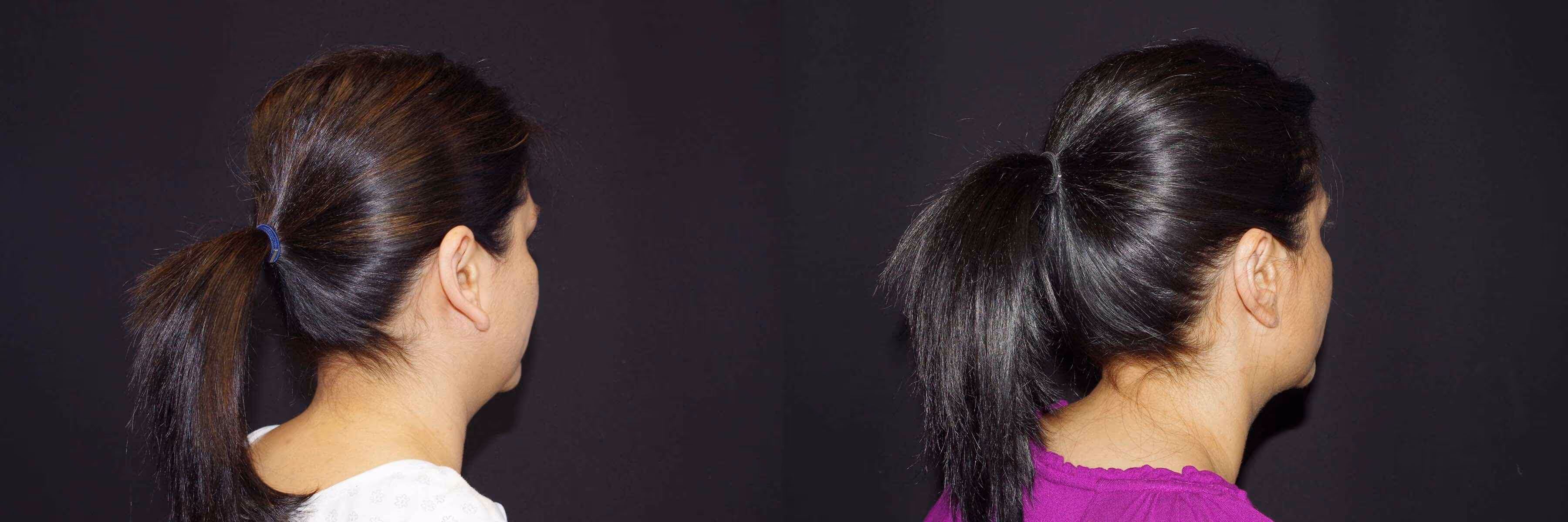 Before And After Patient Image
