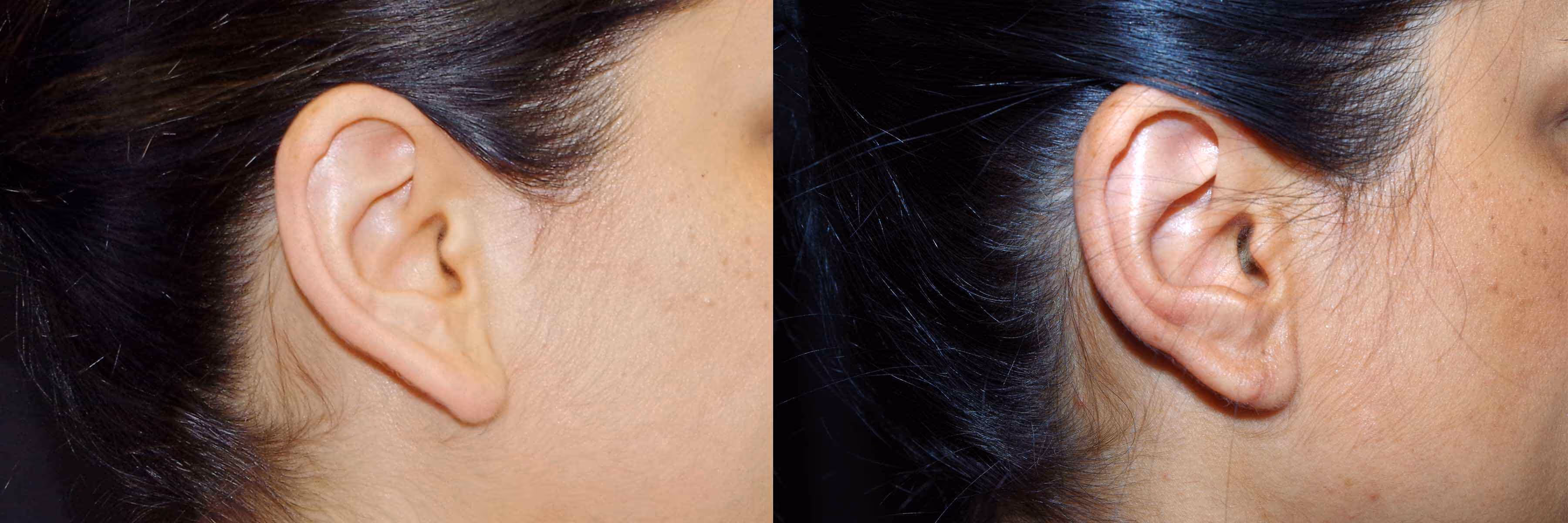 Before And After Patient Image
