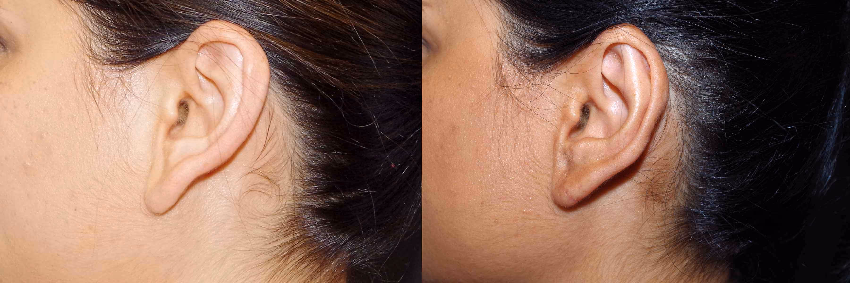 Before And After Patient Image
