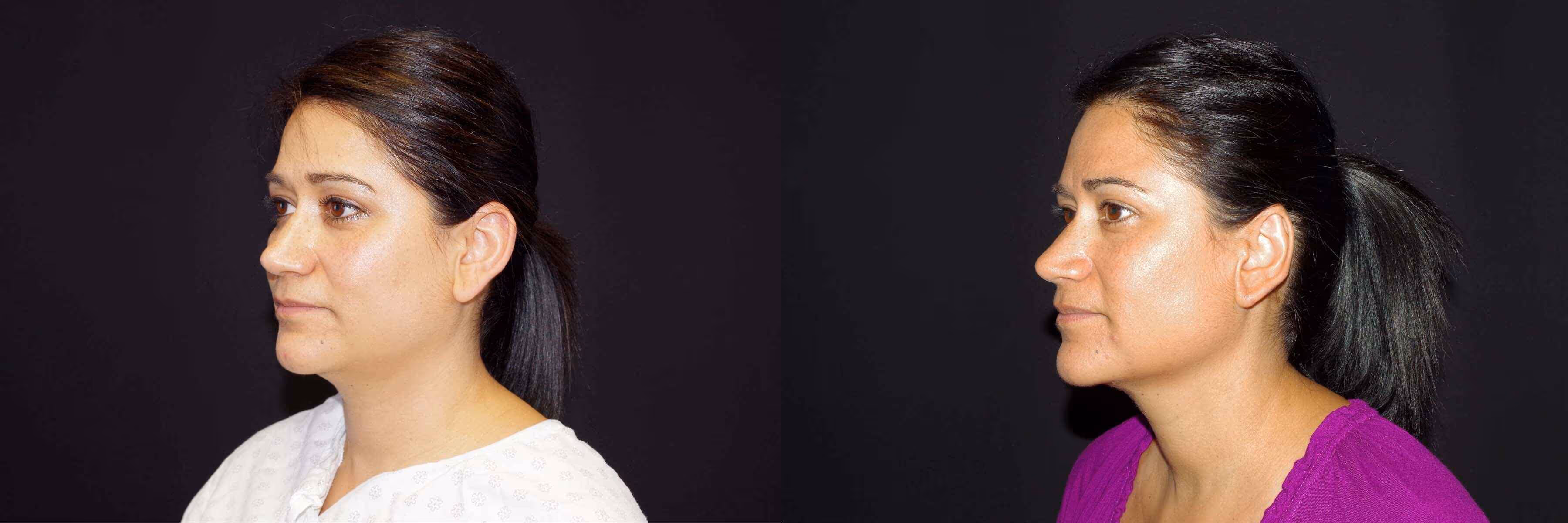 Before And After Patient Image