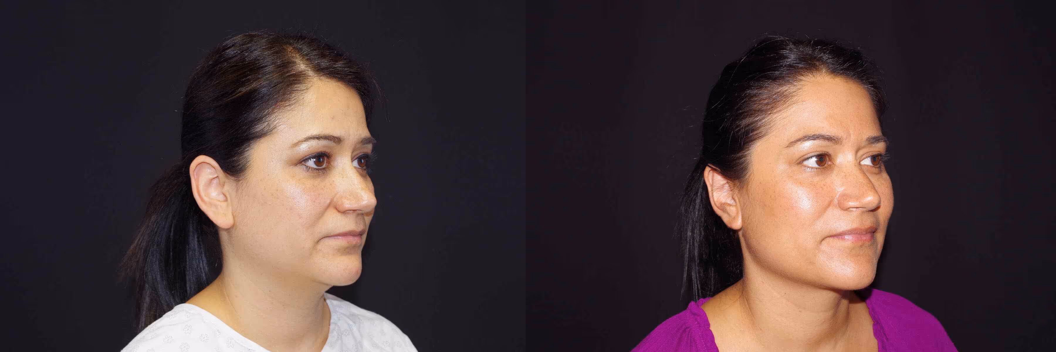 Before And After Patient Image