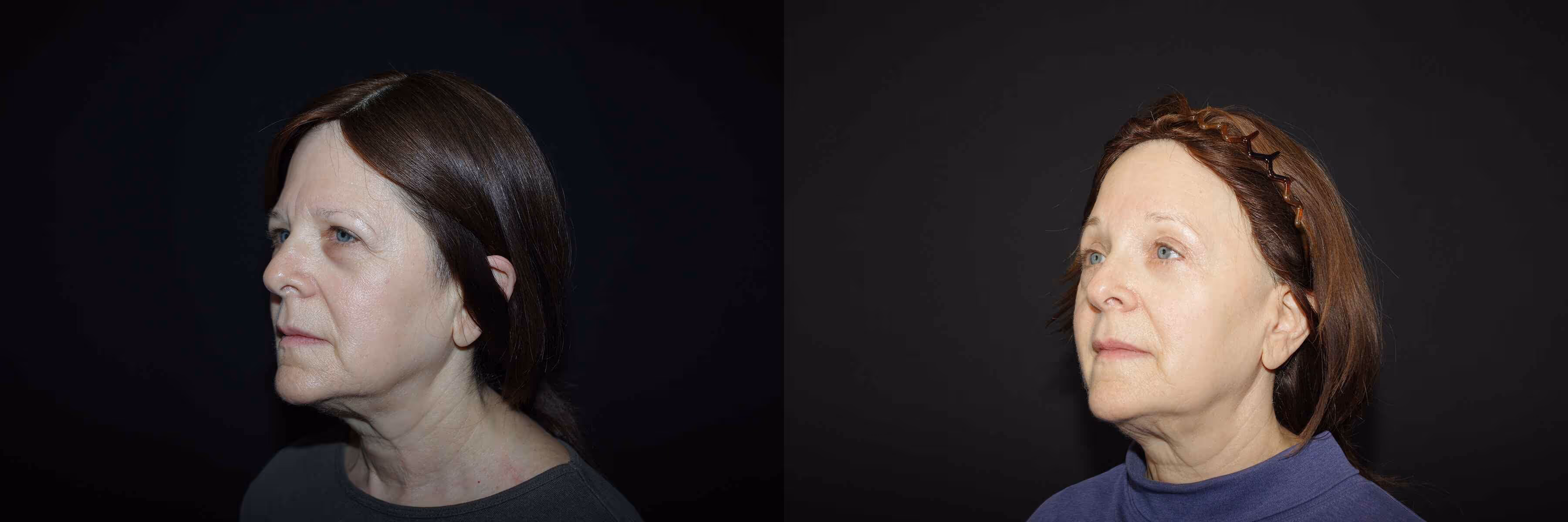 Before And After Patient Image