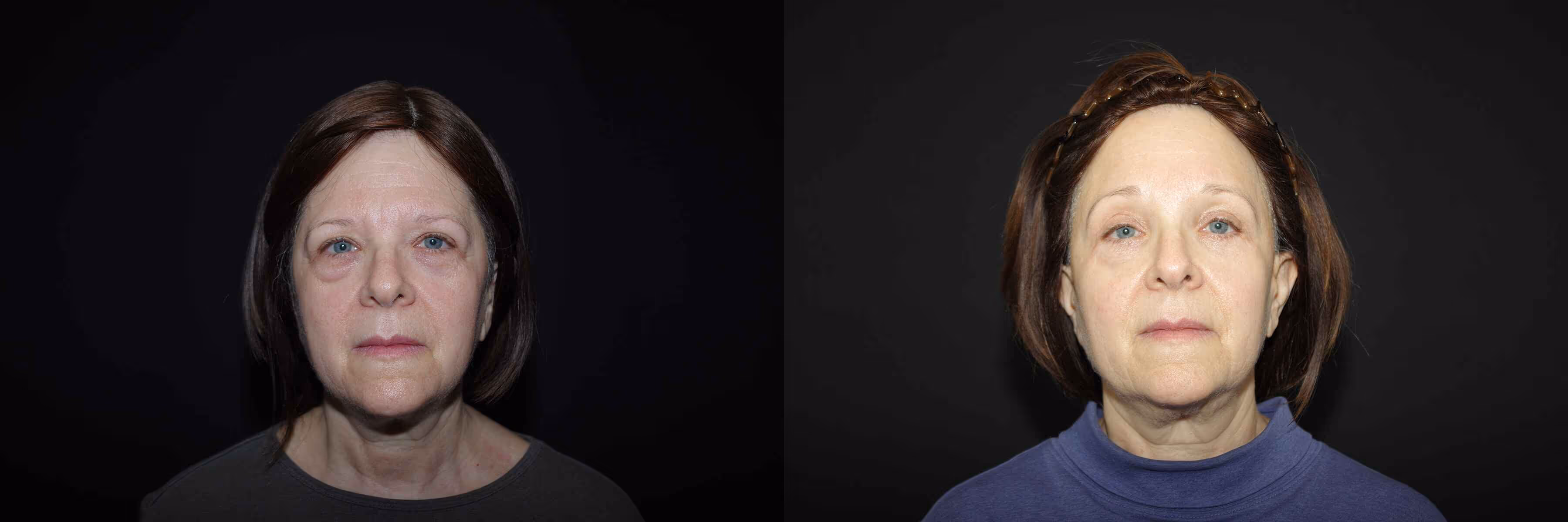 Before And After Patient Image