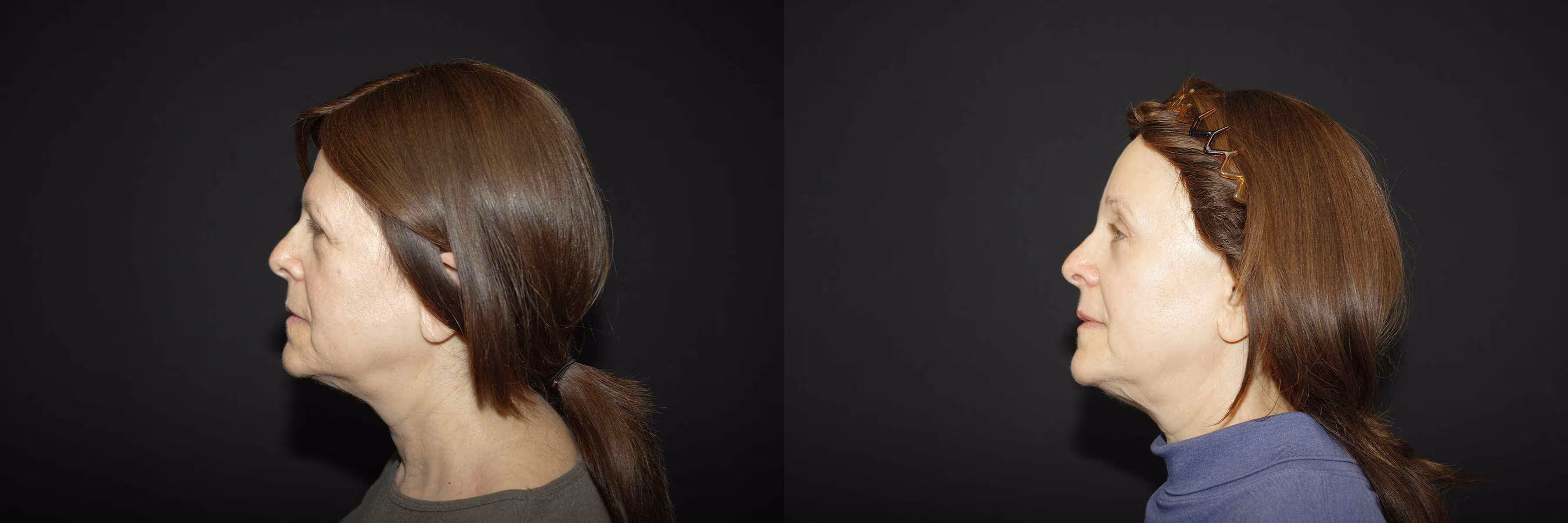 Before And After Patient Image