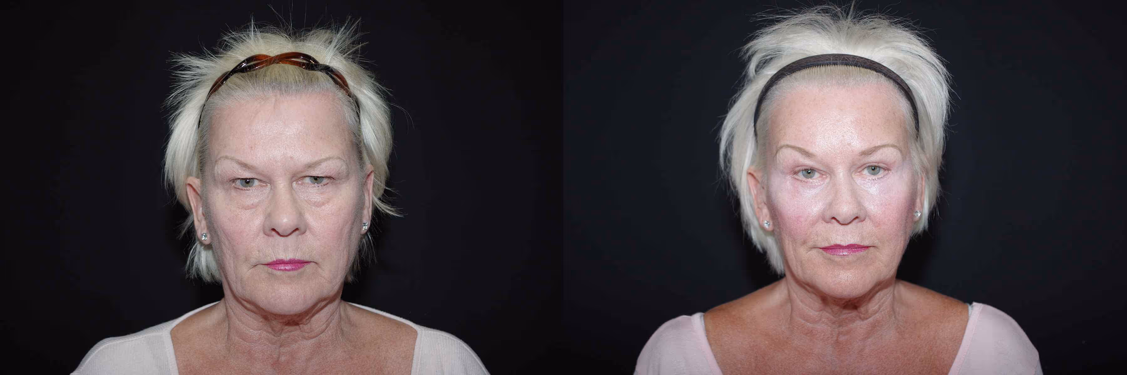 Before And After Patient Image