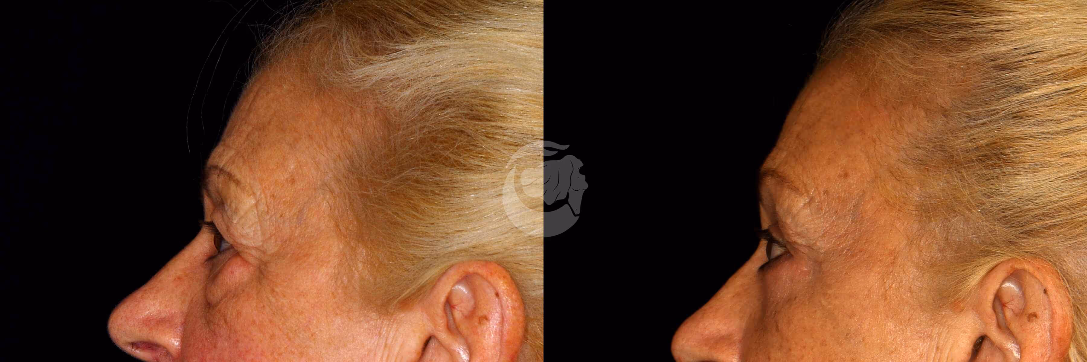 Before And After Patient Image