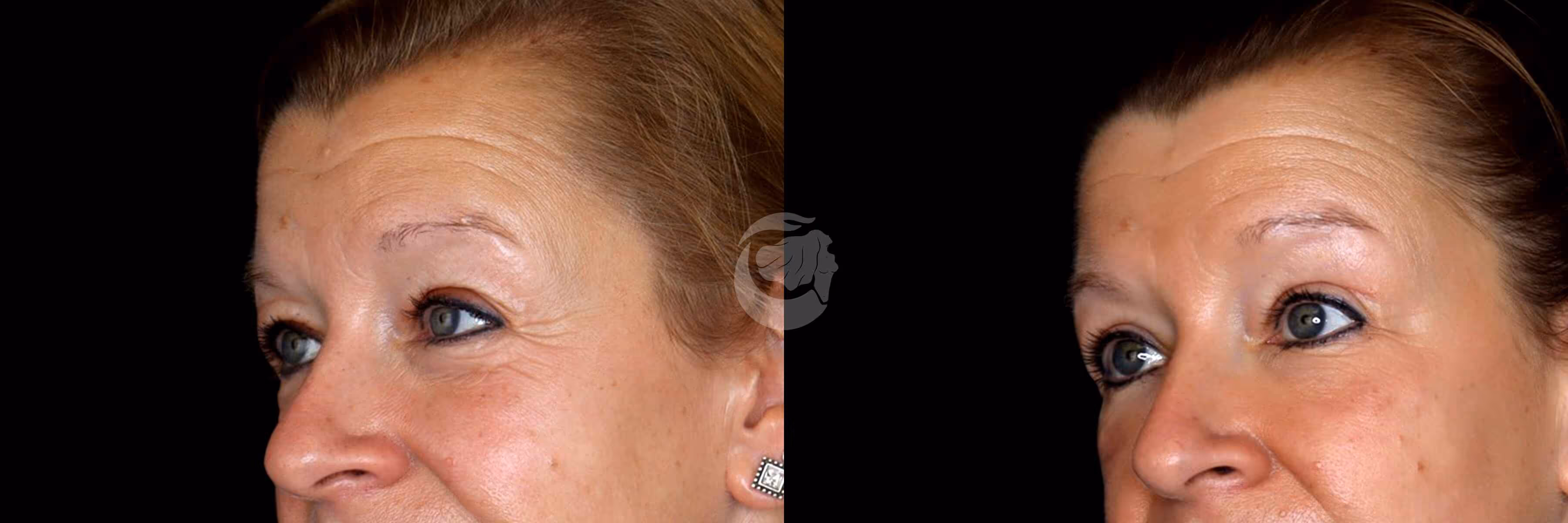 Before And After Patient Image