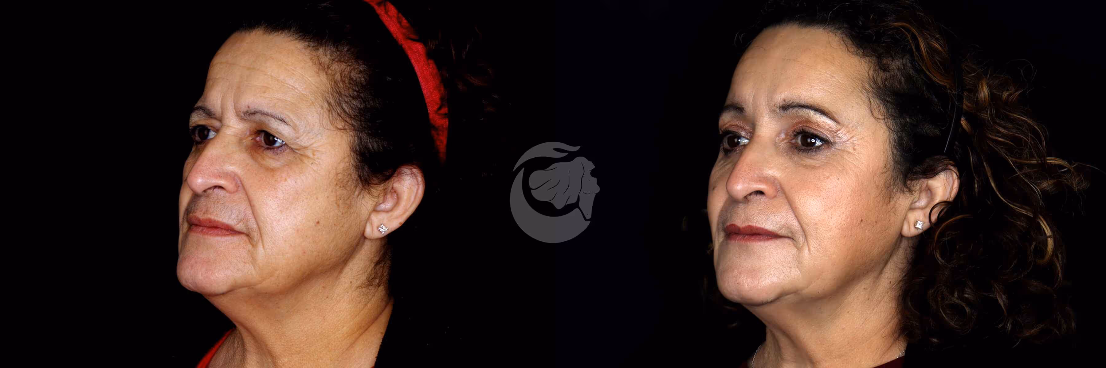 Before And After Patient Image