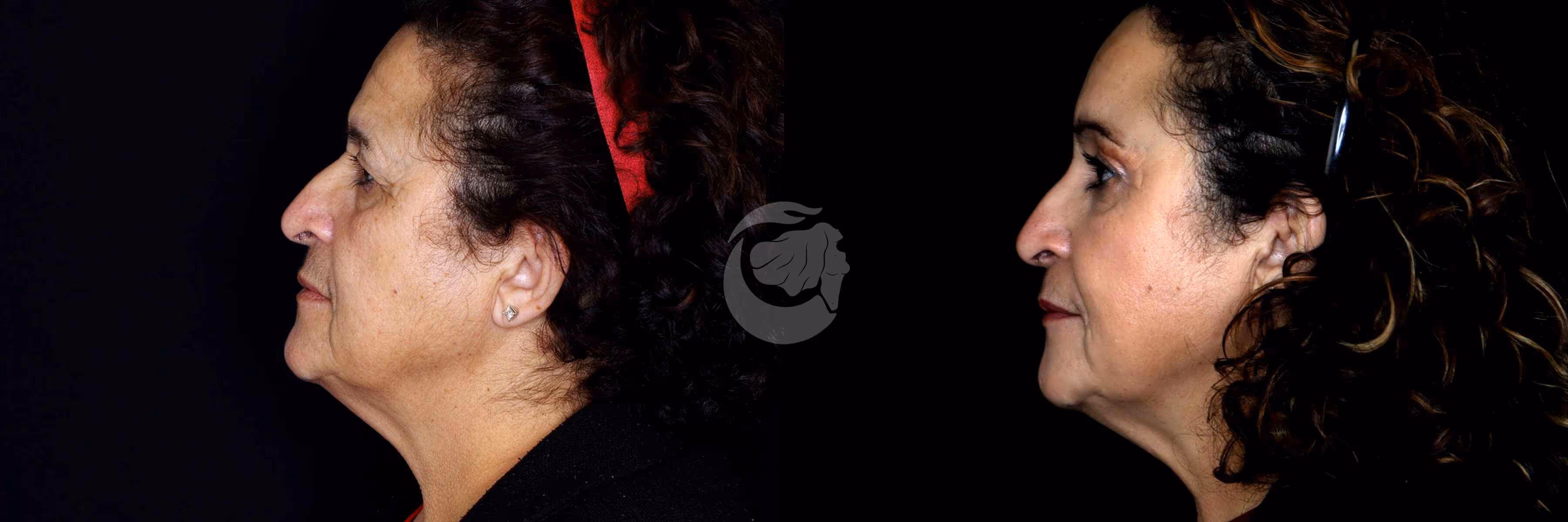 Before And After Patient Image