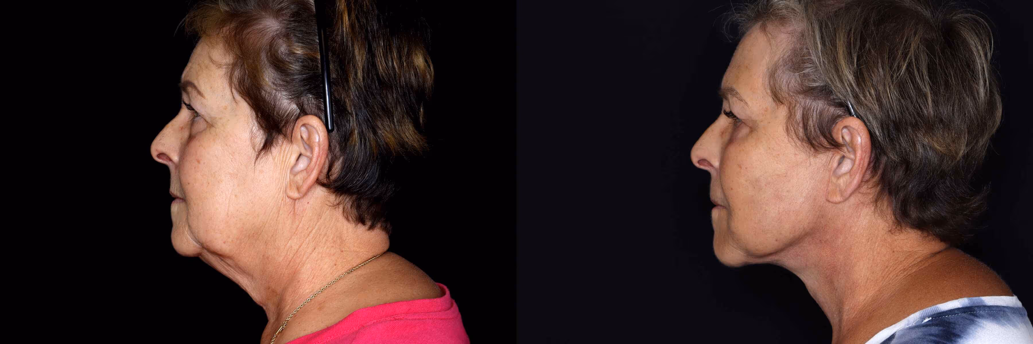 Before And After Patient Image
