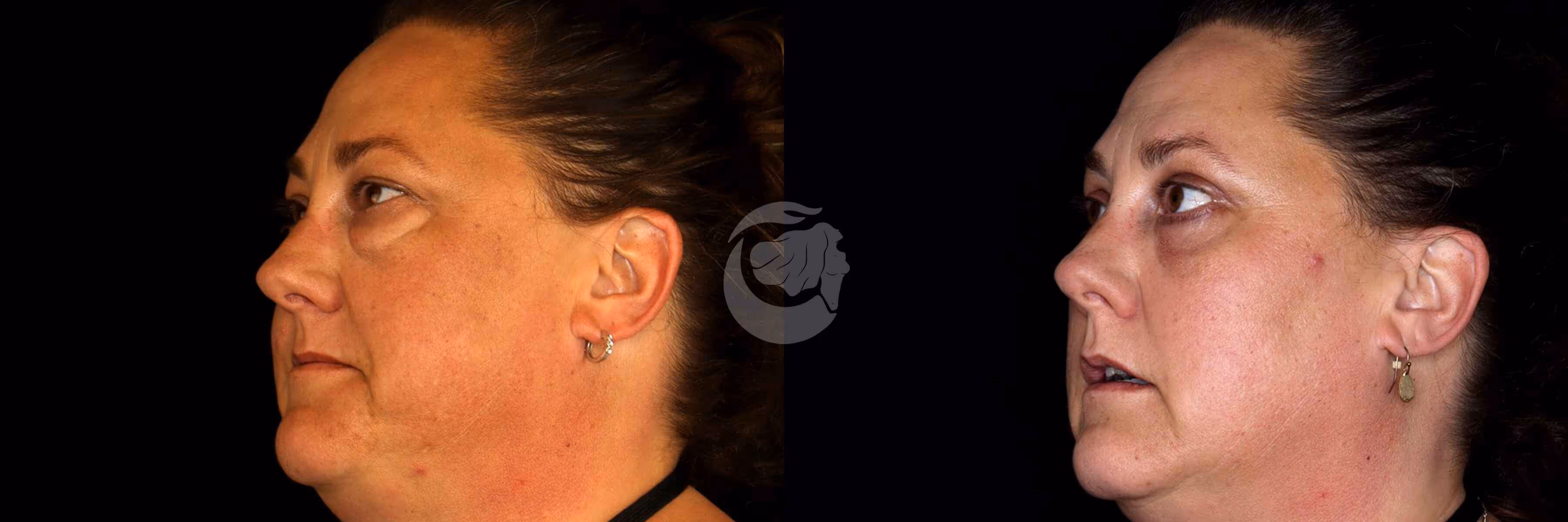 Before And After Patient Image