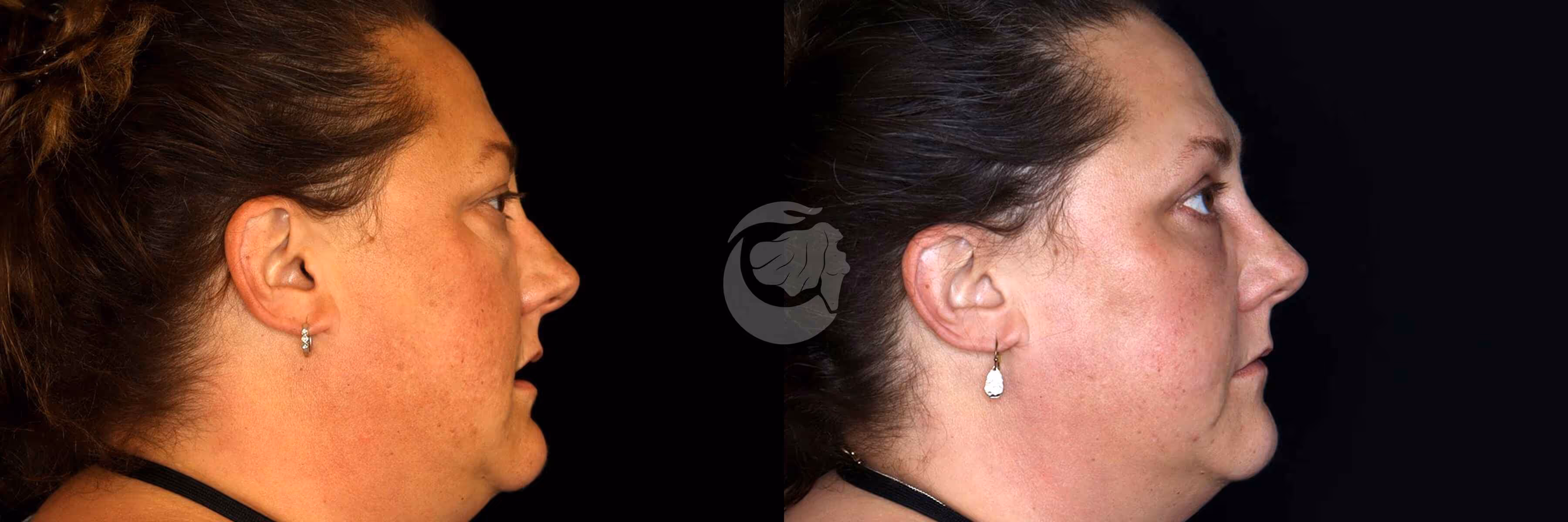 Before And After Patient Image