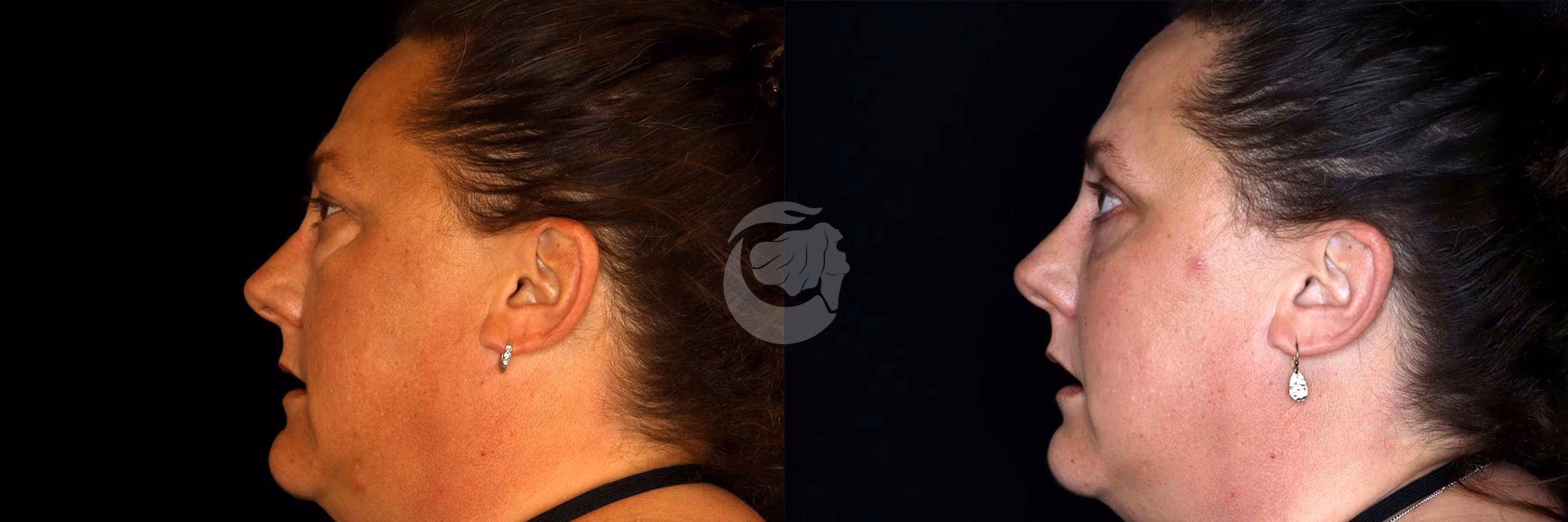 Before And After Patient Image