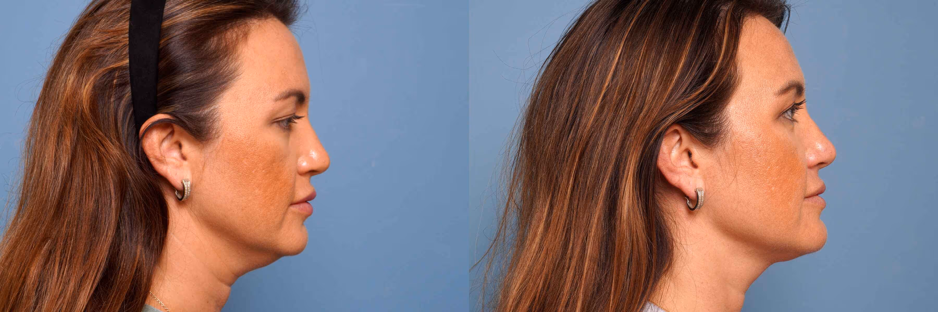 Before And After Patient Image