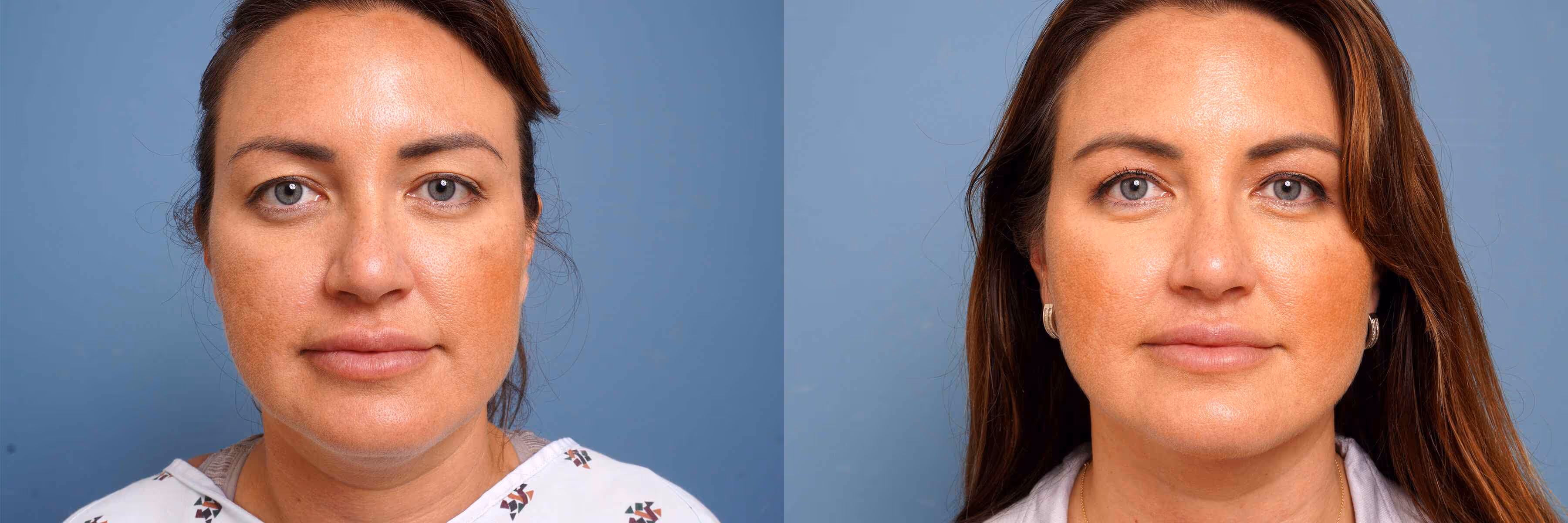 Before And After Patient Image