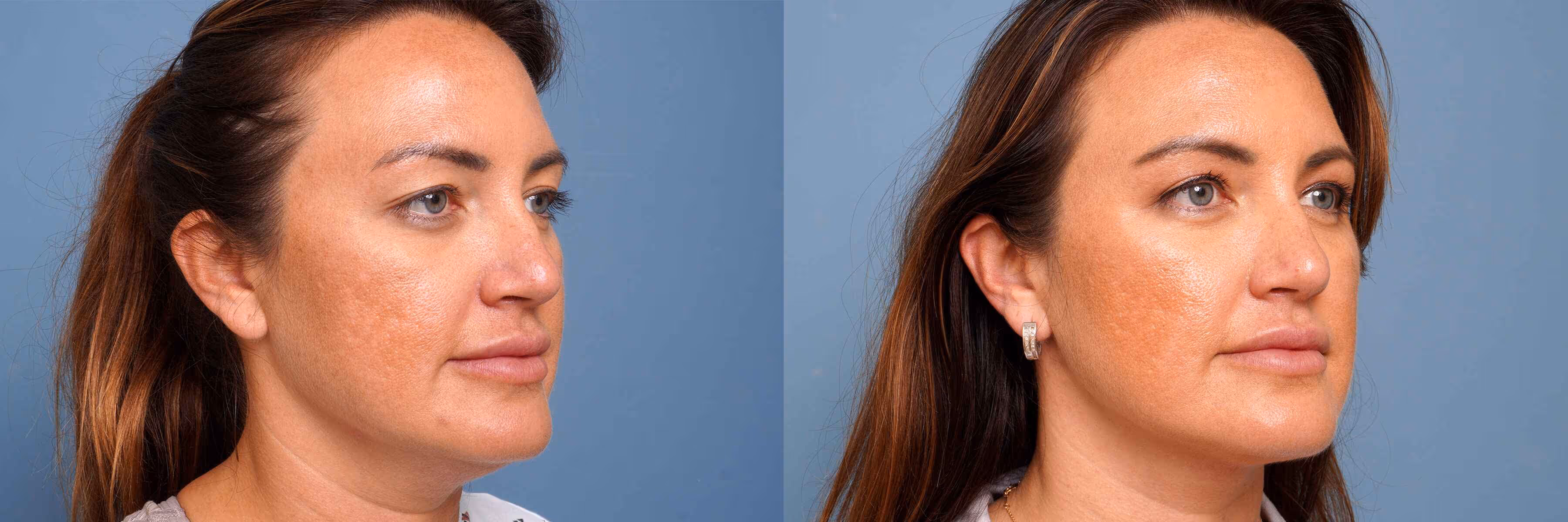Before And After Patient Image