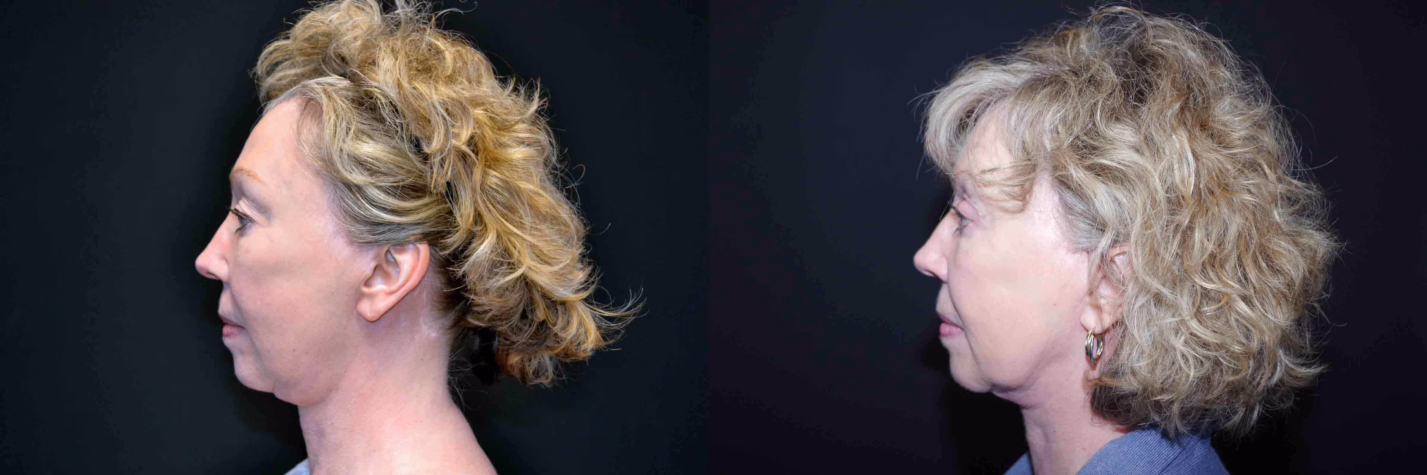 Before And After Patient Image