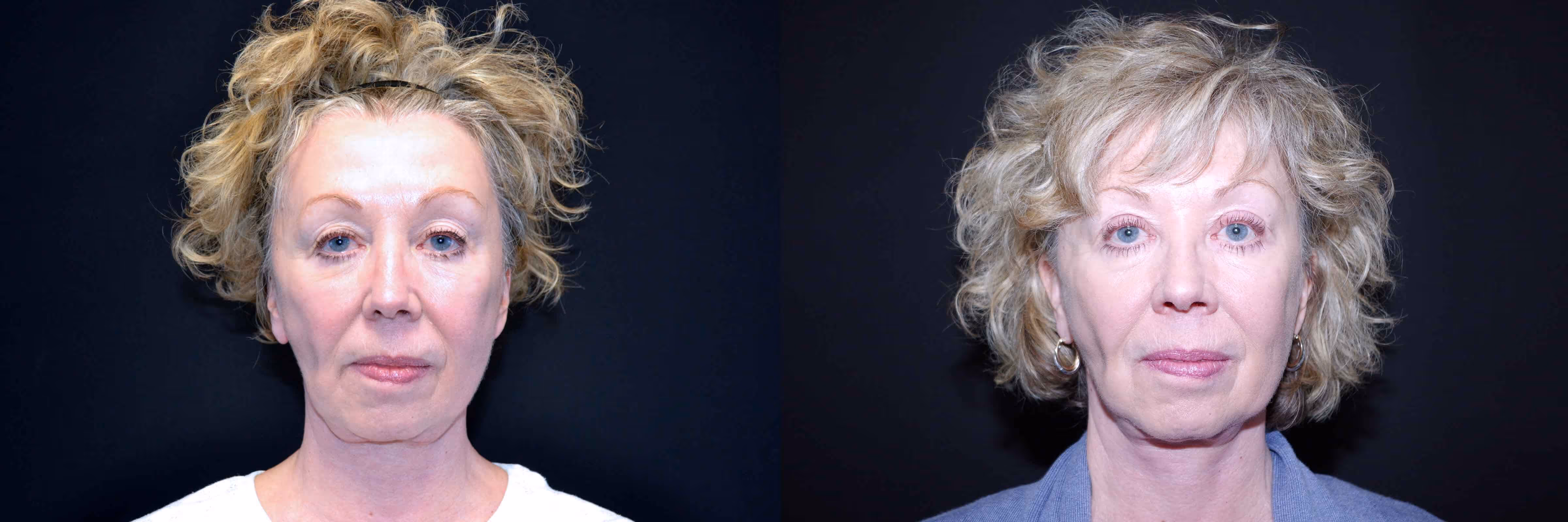 Before And After Patient Image
