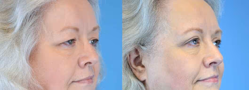 Before And After Patient Image