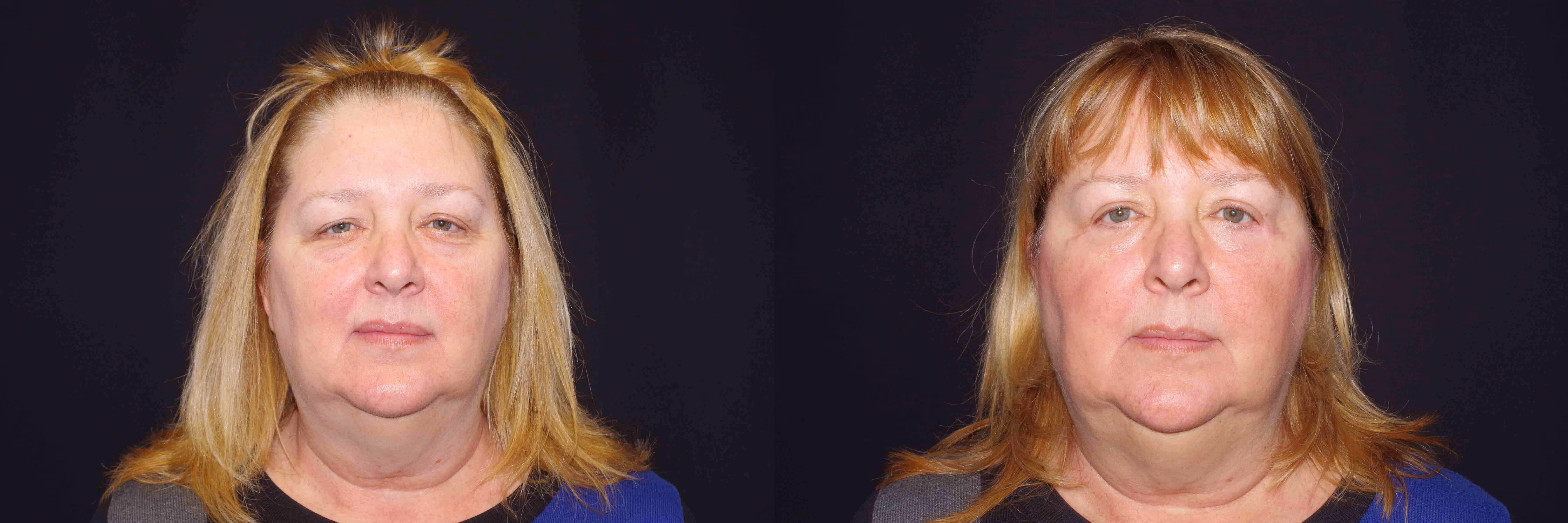 Before And After Patient Image