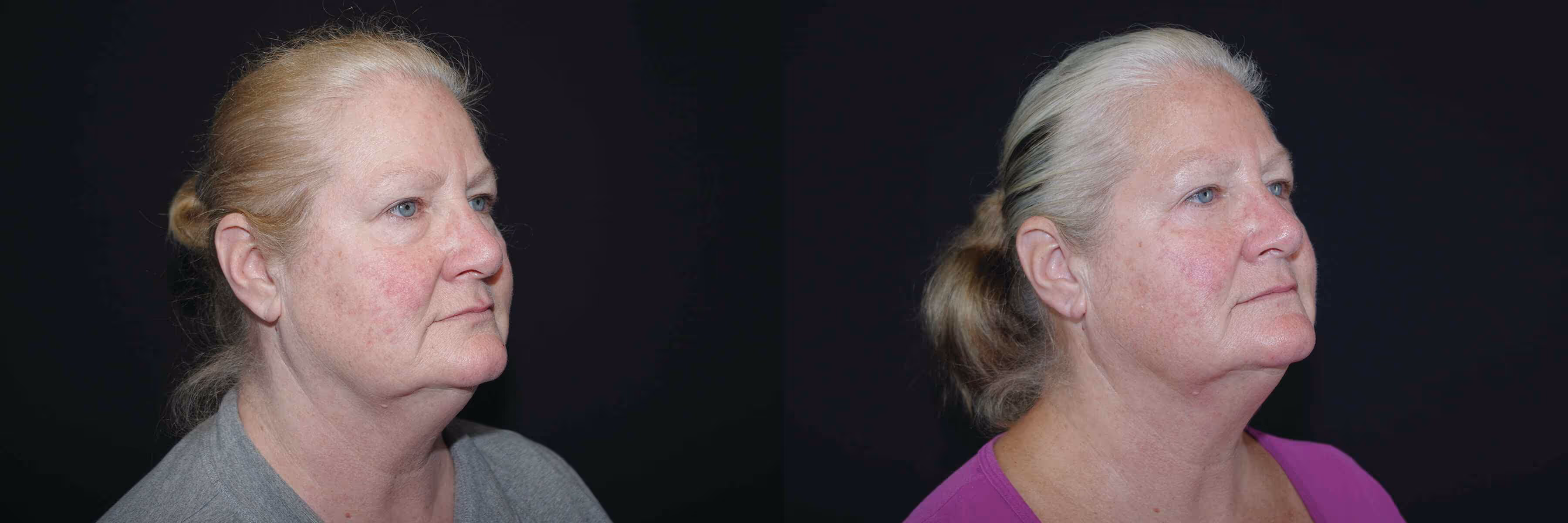 Before And After Patient Image