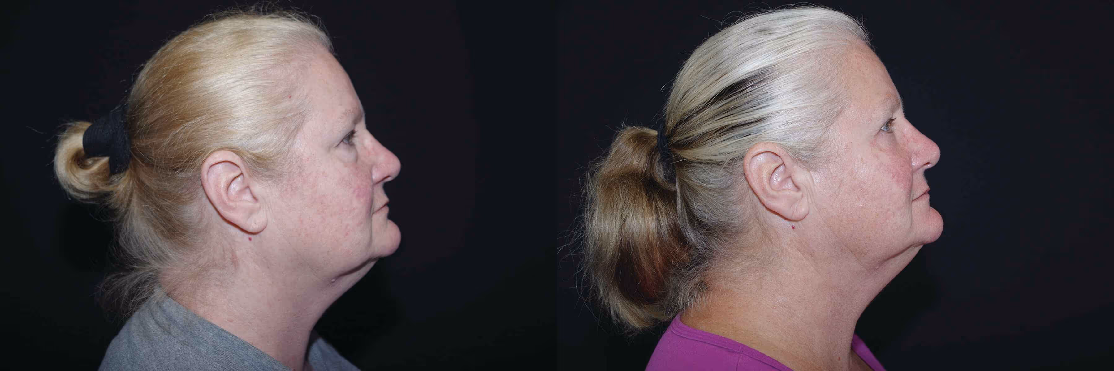 Before And After Patient Image