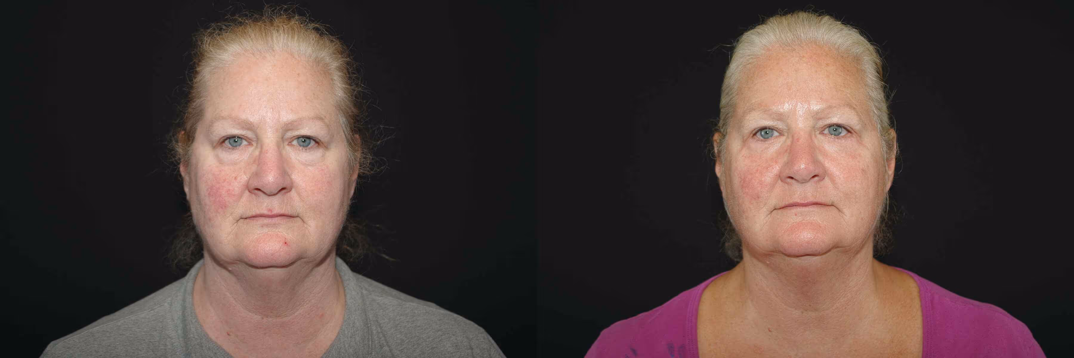 Before And After Patient Image